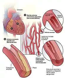 Enfermedad coronaria