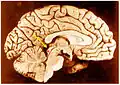 El colículo inferior (punto rojo) en un cerebro humano que se ha cortado por la mitad para mostrar algunas de las áreas subcorticales.