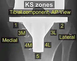 Zonas SR, vista anteroposterior (AP).