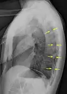 Radiografía lateral en inspiración, que muestra el neumotórax en la parte posterior