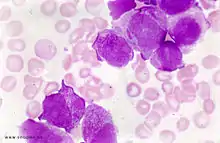  leucemia mieloide aguda