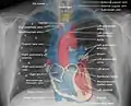 El contorno de la vena cava superior en una radiografía de tórax está etiquetado a la izquierda.