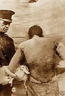 Soldado con quemaduras severas de gas mostaza en su cuerpo y brazos hacia 1918. Estas quemaduras son lo suficientemente severas como para poner en riesgo la vida.
