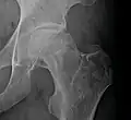 Radiografía de una osteonecrosis de la cabeza femoral izquierda. Hombre de 45 años de edad con SIDA.