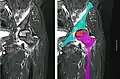 Resonancia magnética nuclear de una osteonecrosis de la cabeza femoral izquierda. Hombre de 45 años de edad con SIDA.