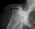Radiografía de una osteonecrosis total de la cabeza del húmero derecho. Mujer de 81 años de edad con diabetes de larga evolución.