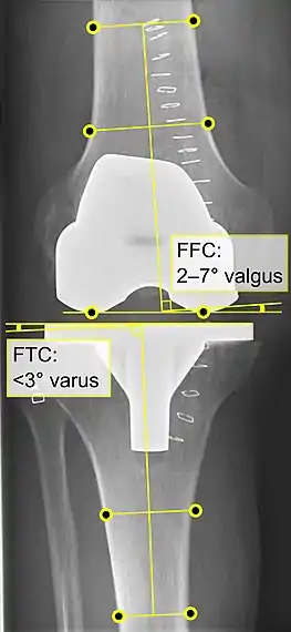 - CFF: ángulo del componente femoral frontal. Por lo general, se considera óptimo cuando se encuentra entre 2 y 7° en valgo.- CTF: ángulo del componente tibial frontal, que se considera óptimo cuando se encuentra en ángulo recto. En general, se ha encontrado que una posición en varo de más de 3 ° aumenta la tasa de falla de la prótesis.