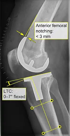 - La entalladura femoral anterior (el componente femoral que causa una reducción del grosor del fémur distal en la parte anterior) parece aumentar el riesgo de fracturas cuando excede aproximadamente 3 mm.- CTL: ángulo del componente tibial lateral (o sagital), que está idealmente posicionado de modo que la tibia esté flexionada de 0 a 7° en comparación con un ángulo recto con la placa tibial.