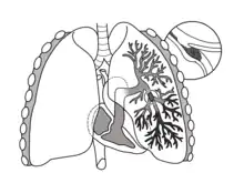 Tromboembolismo pulmonar