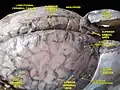 Meninges y venas cerebrales superficiales.Disección profunda.Vista superior.