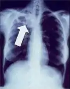 Radiografía de tórax mostrando cavidades en el estadio avanzado de la tuberculosis, los focos de Ghon tienden a ser más pequeños.