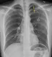 radiografía anteroposterior que muestra un neumotórax de reducido tamaño en el pulmón izquierdo, causado por una punción