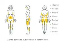 zonas lipoescultura