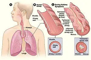 Figure A shows the location of the lungs and airways in the body. Figure B shows a cross-section of a normal airway. Figure C shows a cross-section of an airway during asthma symptoms.