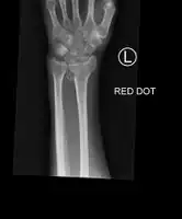 Colles fracture (Pouteau fracture), Radiology Case