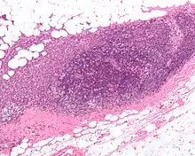 Micrograph showing a lymph node invaded by ductal breast carcinoma, with an extension of the tumor beyond the lymph node.