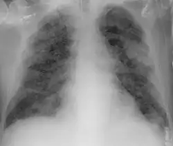 Chest X-ray showing COVID-19 pneumonia