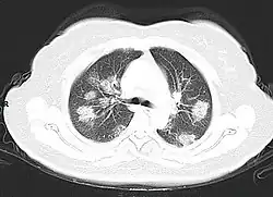 A CT scan of a person with COVID-19 shows lesions (bright regions) in the lungs
