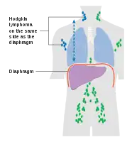 Stage 2 Hodgkin lymphoma