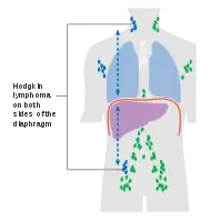Stage 3 Hodgkin lymphoma