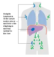 Stage 4 Hodgkin lymphoma