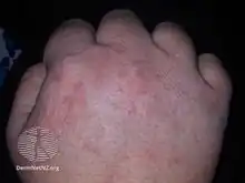 Hand dermatitis in a patient with COVID-19 infection