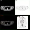 F-18 FDG PET/CT: A breast cancer metastasis to the right scapula