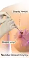 Needle breast biopsy.