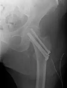 Hip Fractures - OrthoInfo - AAOS