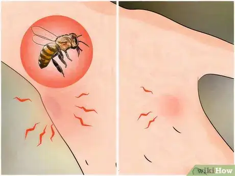 Image intitulée Identify a Spider Bite Step 5