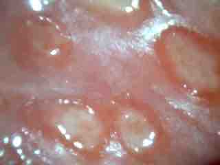 Genital Ulcers