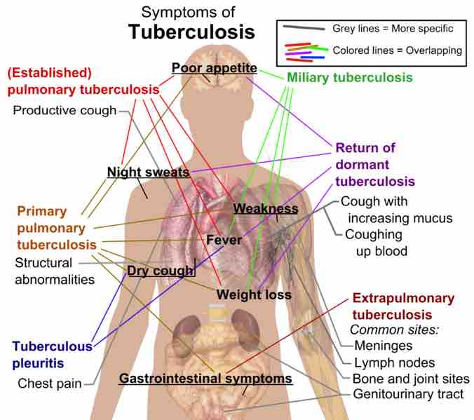 Symptoms of tuberculosis