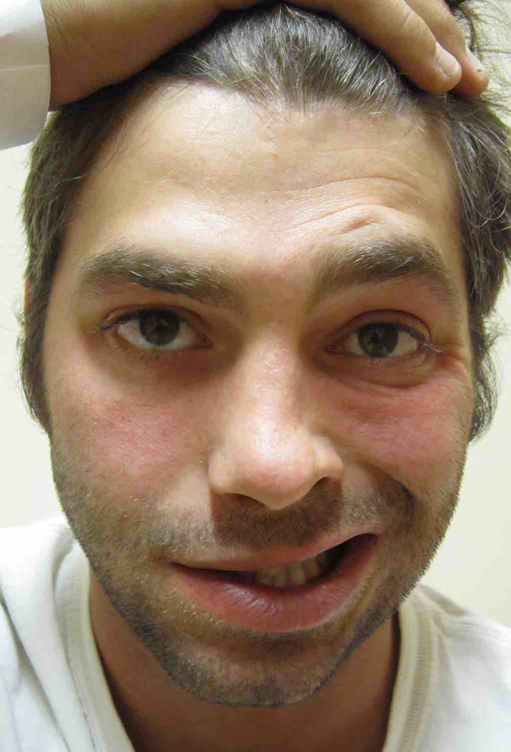 Bell's Palsy