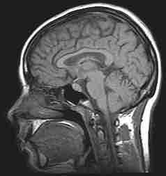 MRI of the human brain