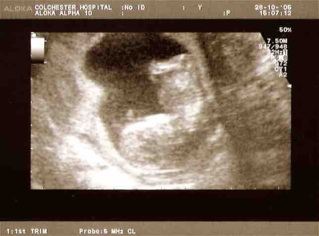 Ultrasound scan