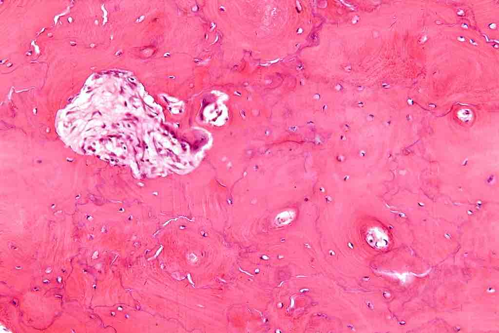 Paget's disease bone tissue