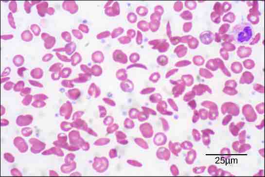 Sickle cell disease