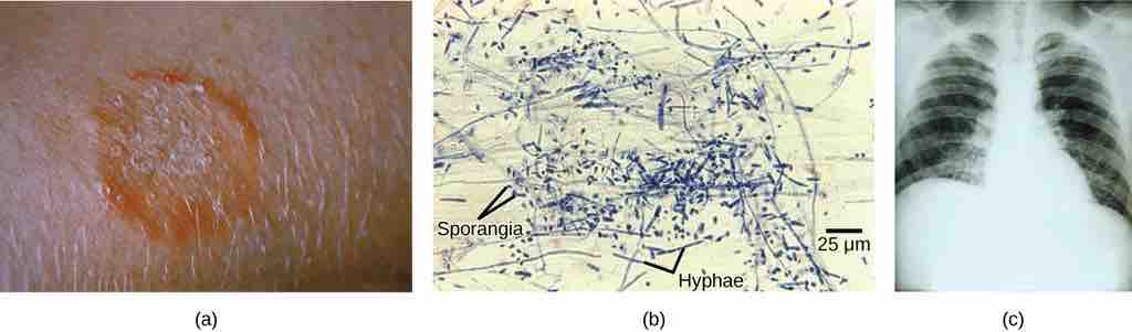 Mycosis infection