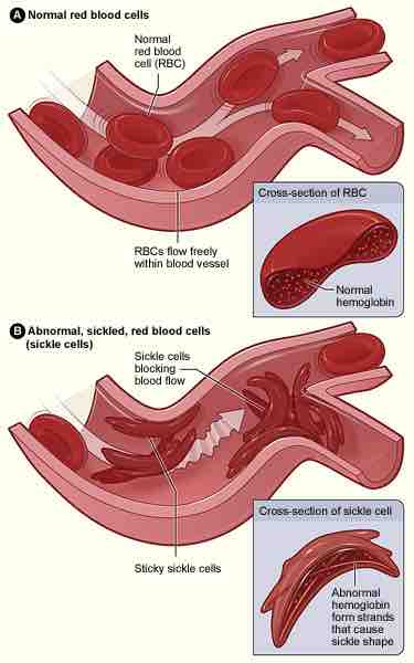 Sickle-cell disease