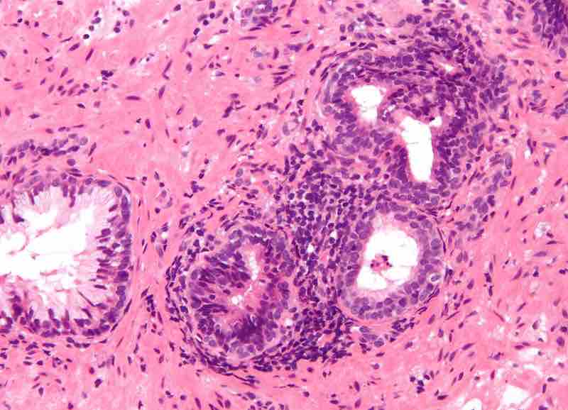 Histologic image of chronic prostatitis