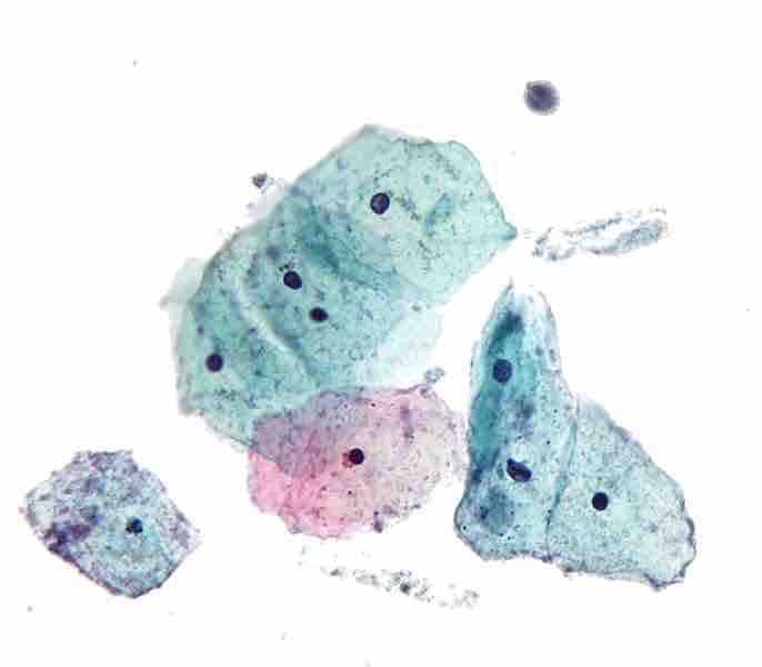 Micrograph showing Trichomoniasis