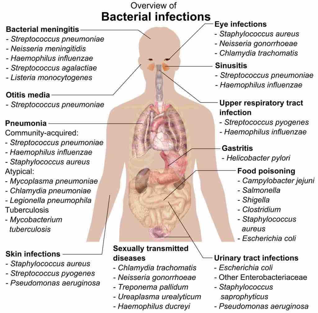 Bacterial infections of the human body