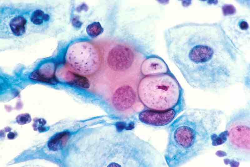 Pap smear with Chlamydia