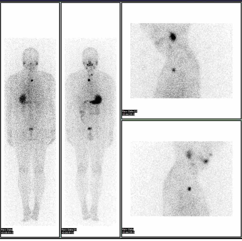 Iodine-123 whole-body scan