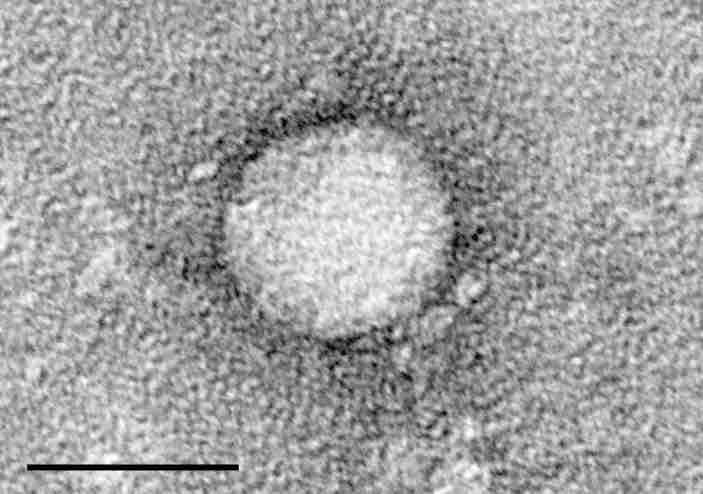 Electron micrograph of Hepatitis C