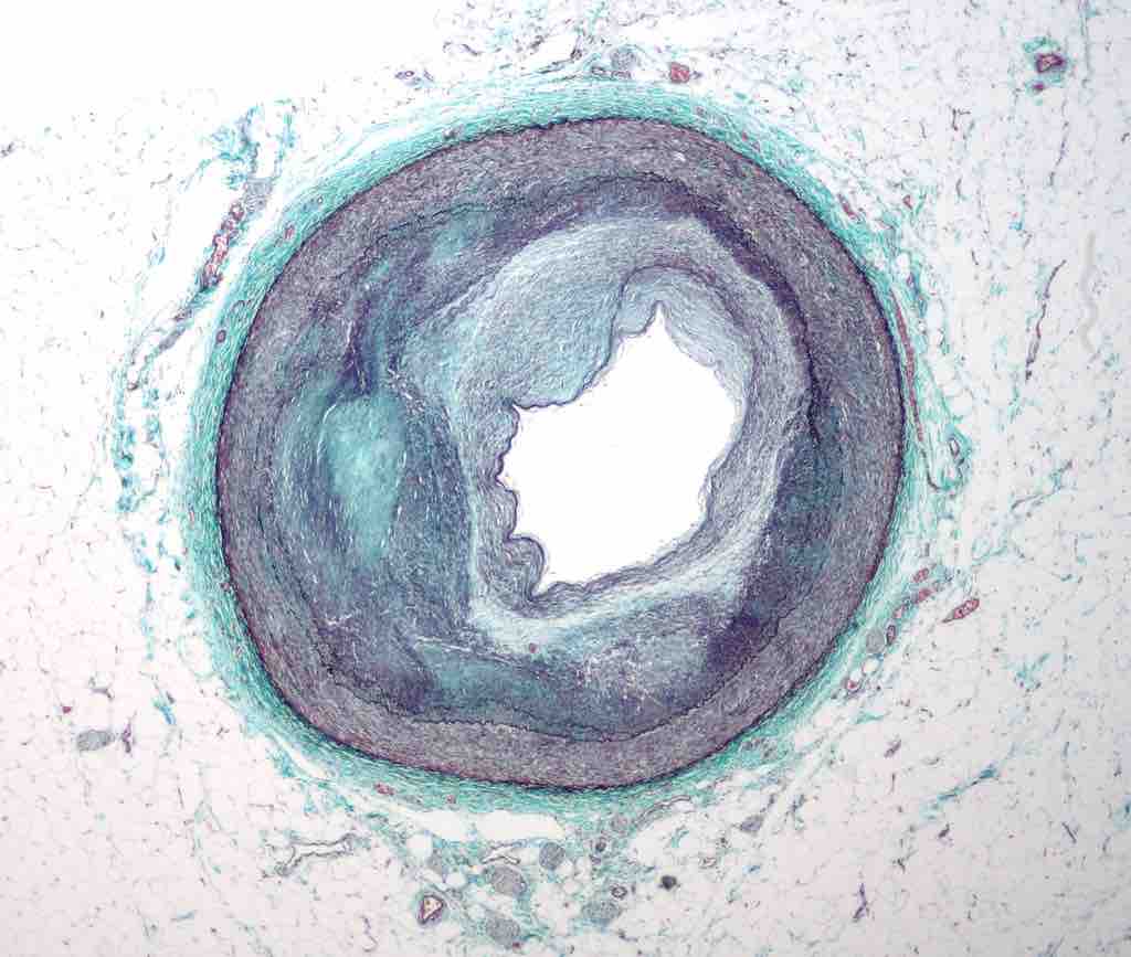 Cross-section of a Artery with Atherosclerosis
