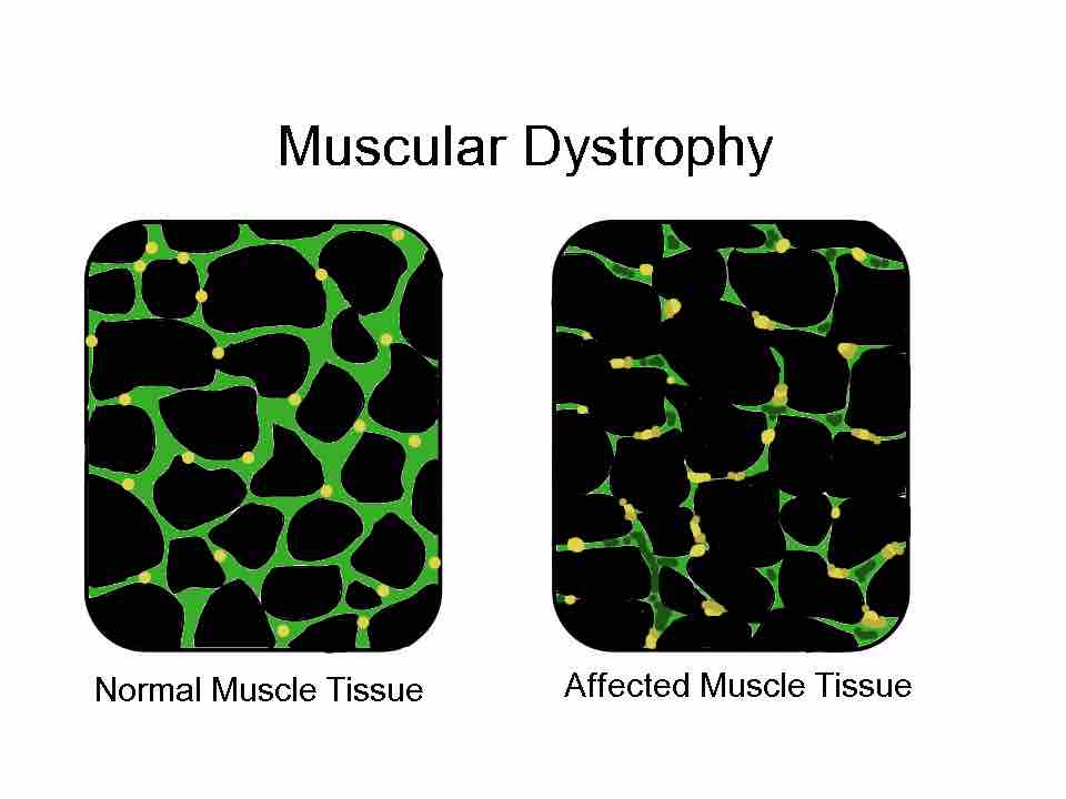 Muscular Dystrophy