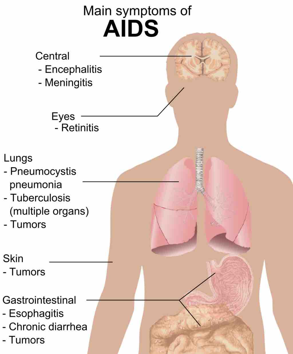 Main Symptoms of AIDS