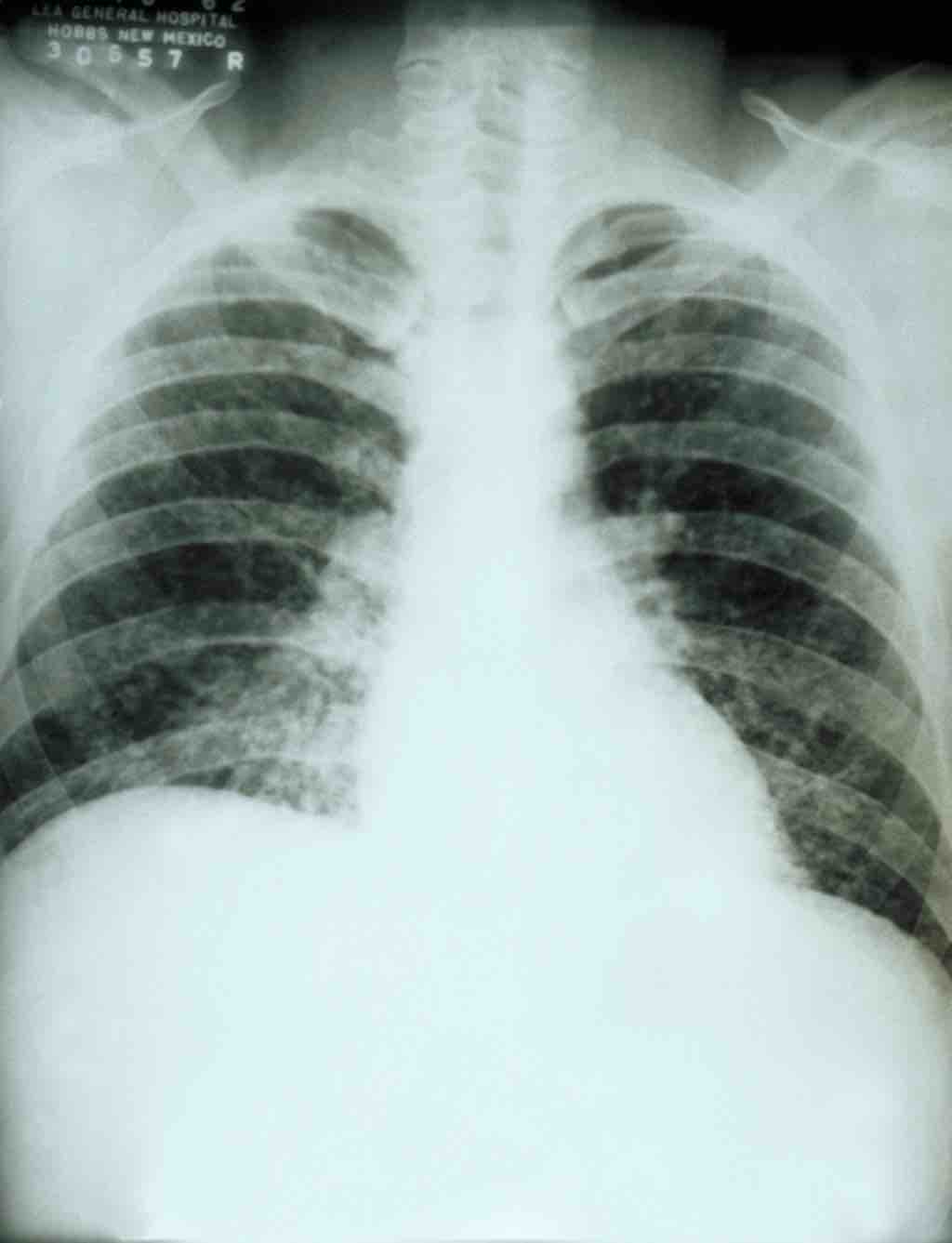 Acute pulmonary histoplasmosis