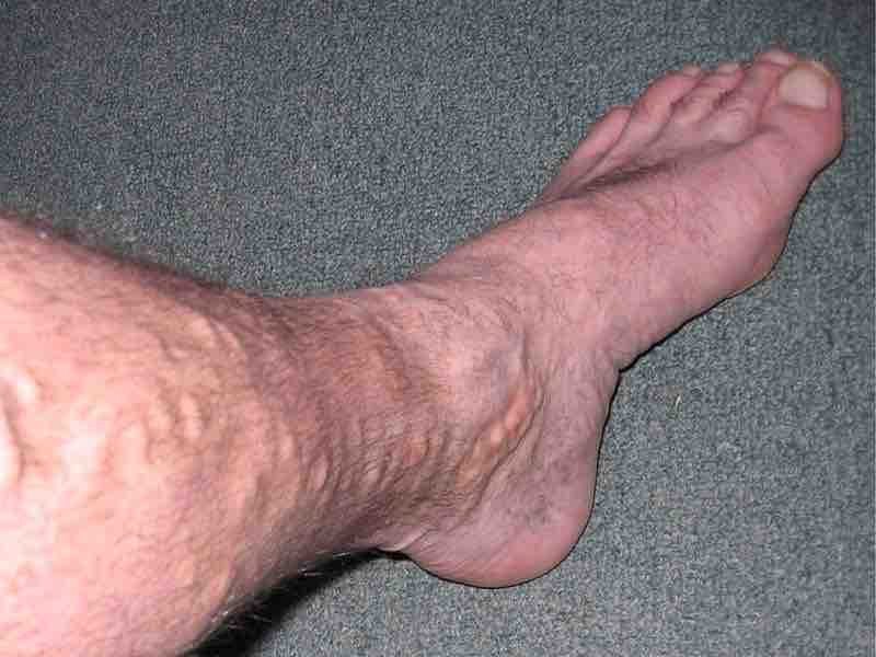 Leg with Varicose Veins